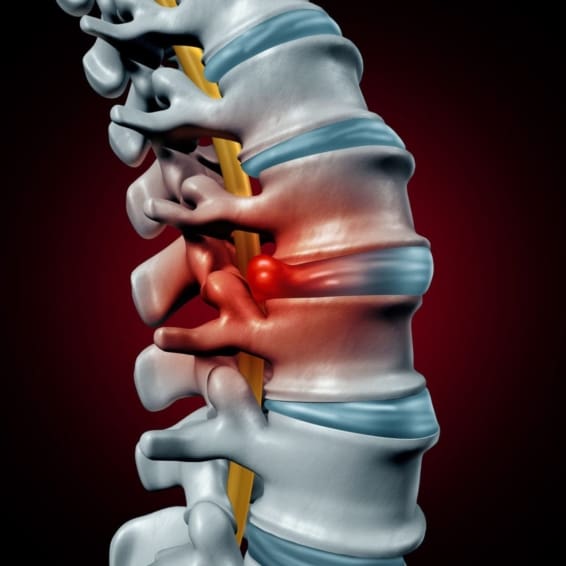 illustration of a spinal column with a herniated disk