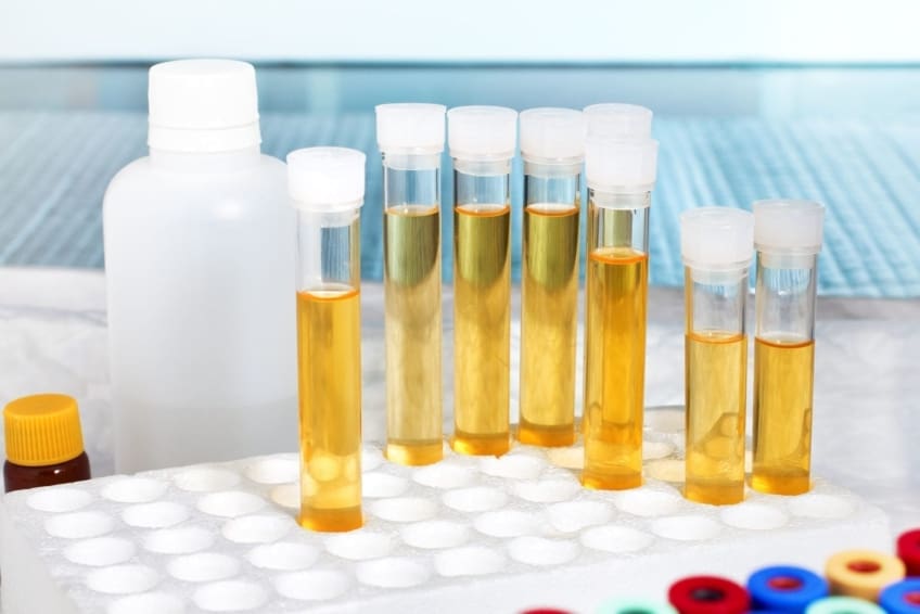 A laboratory rack with several tubes of urine ready for analysis