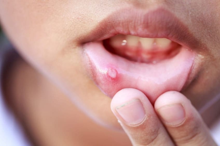 Close-up of child with canker sore on inside of lip