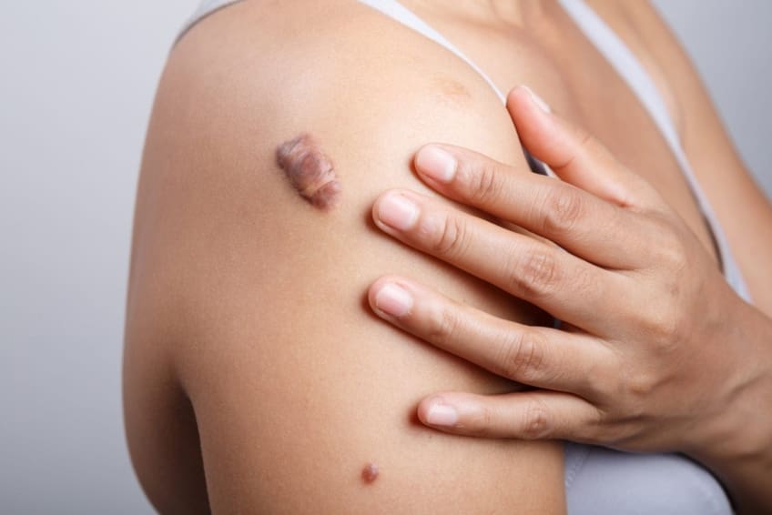 woman with a keloid or raised scar on her shoulder