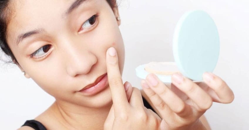 Acne is a common skin condition. It causes pimples to appear on the face and/or on the back, chest, arms, and neck.