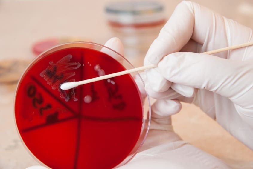 Cotton swab with fluid sample for lab test to diagnose meningitis
