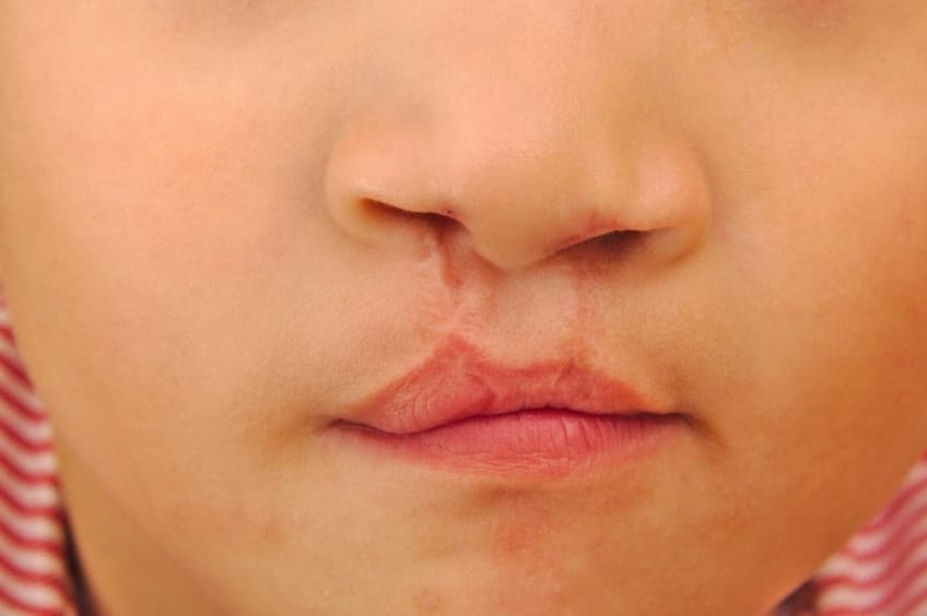 Close up of a child's cleft lip