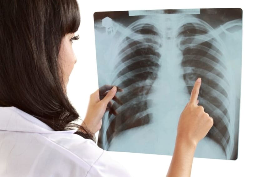 A female doctor examines X-ray of a patient’s lungs looking for signs of lung cancer. Lung cancer is abnormal growth of cells in the lungs. It is one of the most common forms of cancer in the world.
